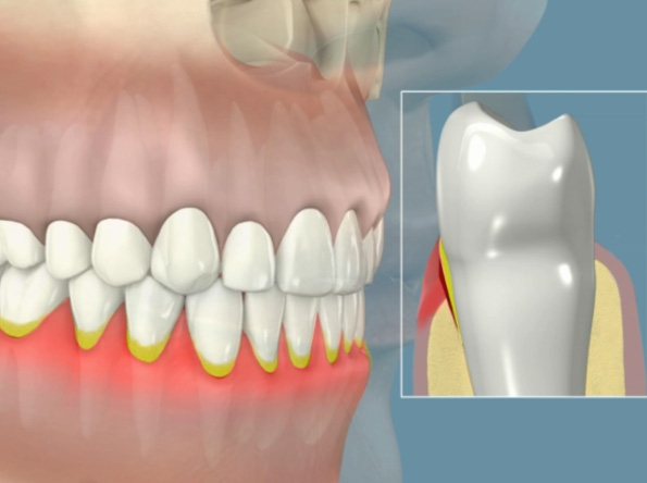 paradontite - Odontoiatrica Urciuolo - Studio dentistico Ladispoli - dentista