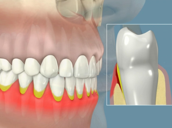 paradontite - Odontoiatrica Urciuolo - Studio dentistico Ladispoli - dentista