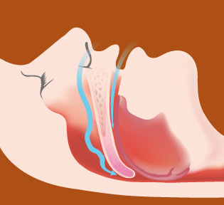 APNEA OSTRUTTIVA NOTTURNA