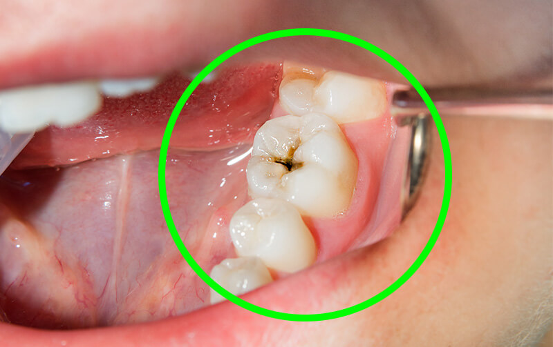 dente cariato – Odontoiatrica Urciuolo