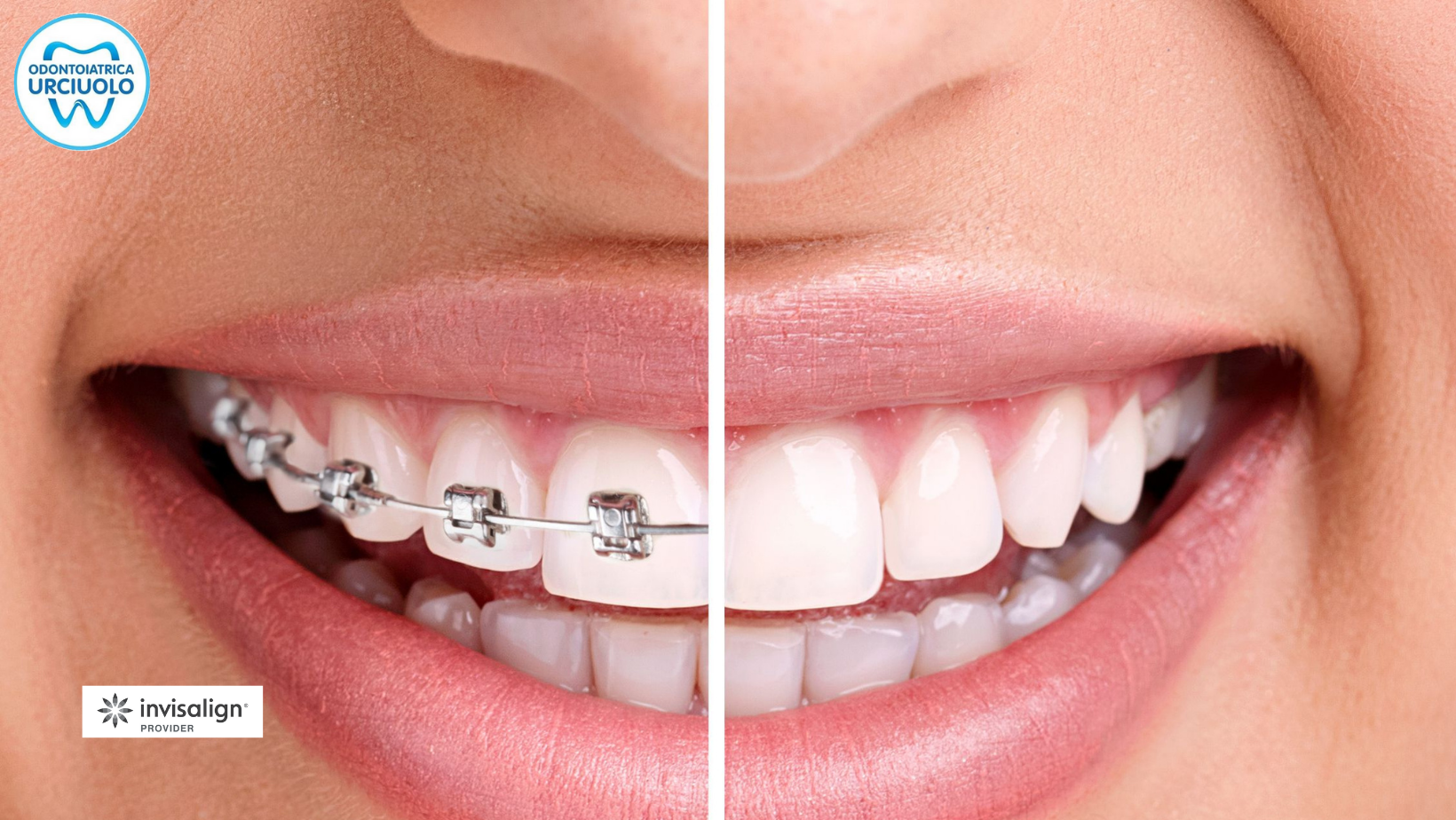 invisalign per bambini e adolescenti